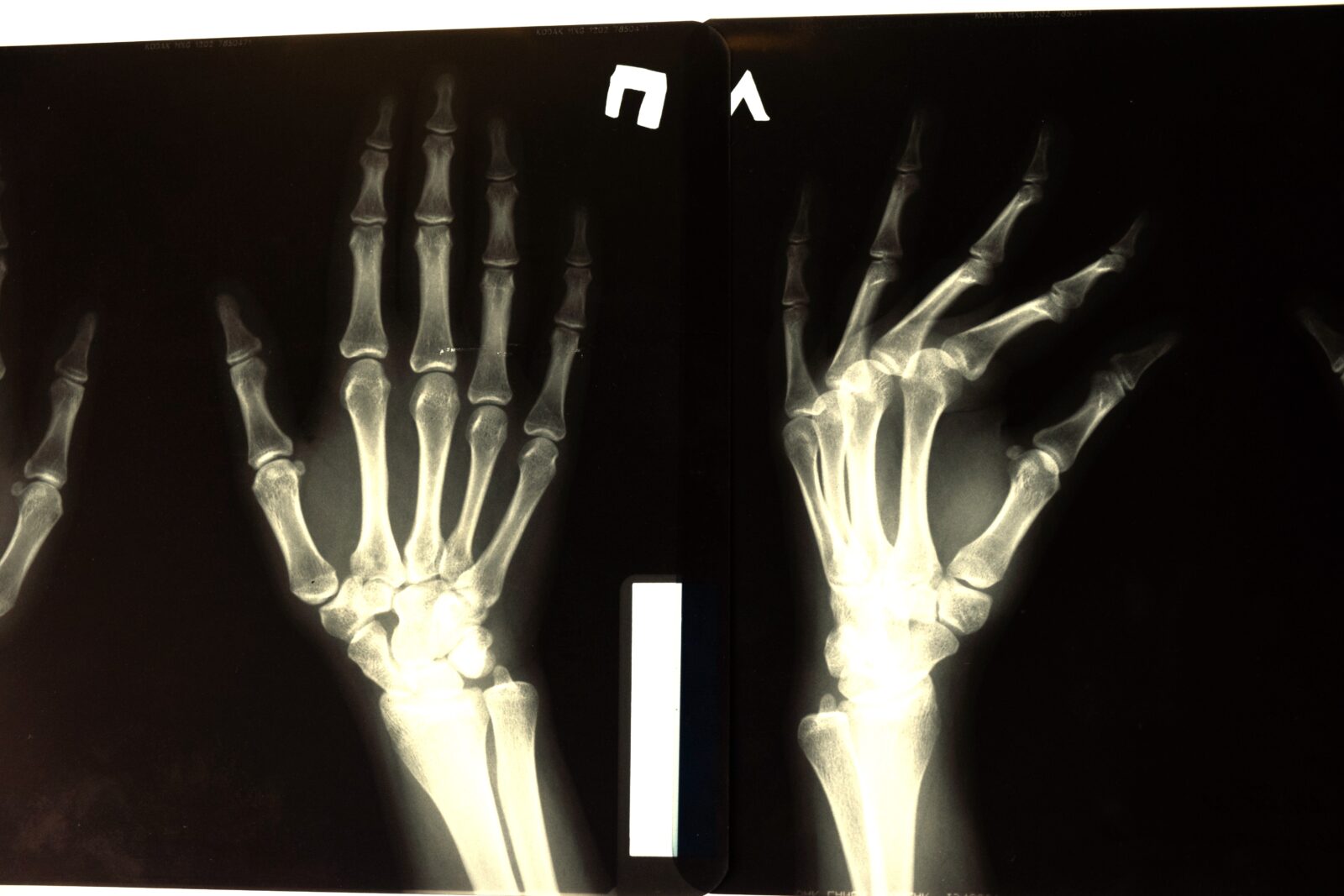 common hand injuries after car accident